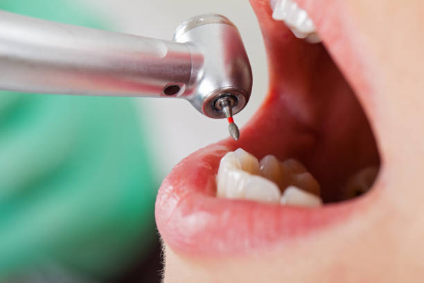 Best Emergency Treatment for Dental Infections or Abscesses in Glasgow, MT